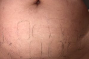 patch marks